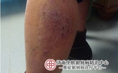 银屑病为什么越抓越痒？主任提醒：这5种个关键点要明白