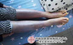 斑块状银屑病传染么？专家详解：这10个诱因更关键