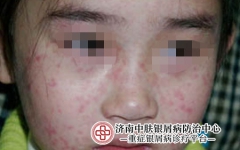 得了牛皮癣，使用其他方治疗需谨慎