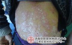 银屑病患者的舌苔变化：中医诊断小贴士