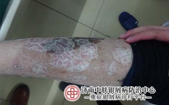 银屑病槐花茶：天然疗法还是心理安慰？