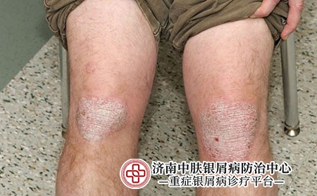 斑块状银屑病3