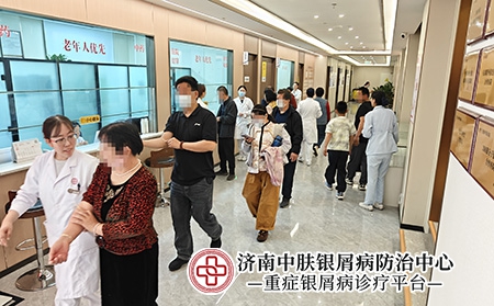 济南红皮病型银屑病诊疗-济南中肤医院